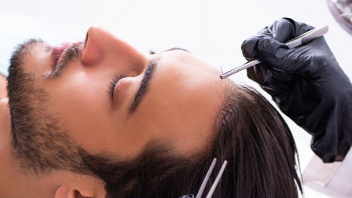 Affordable FUE Hair Transplant treatments