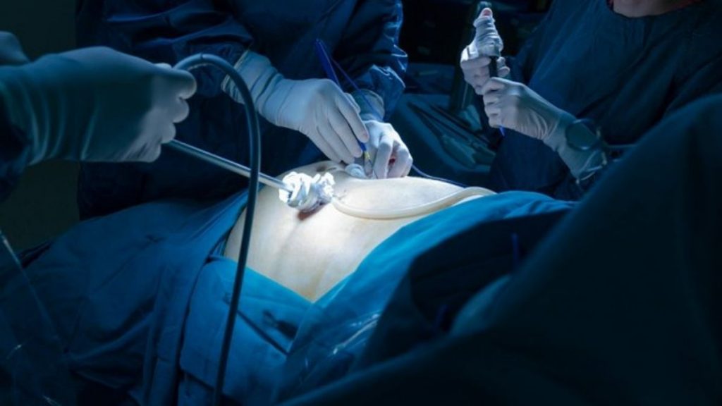 Study shows how life turned out for patients after 10 years of obesity surgery